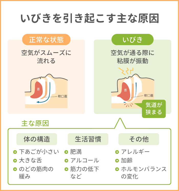 夫の爆音いびきは病気の警告？妻の睡眠危機を救う最新医学対策