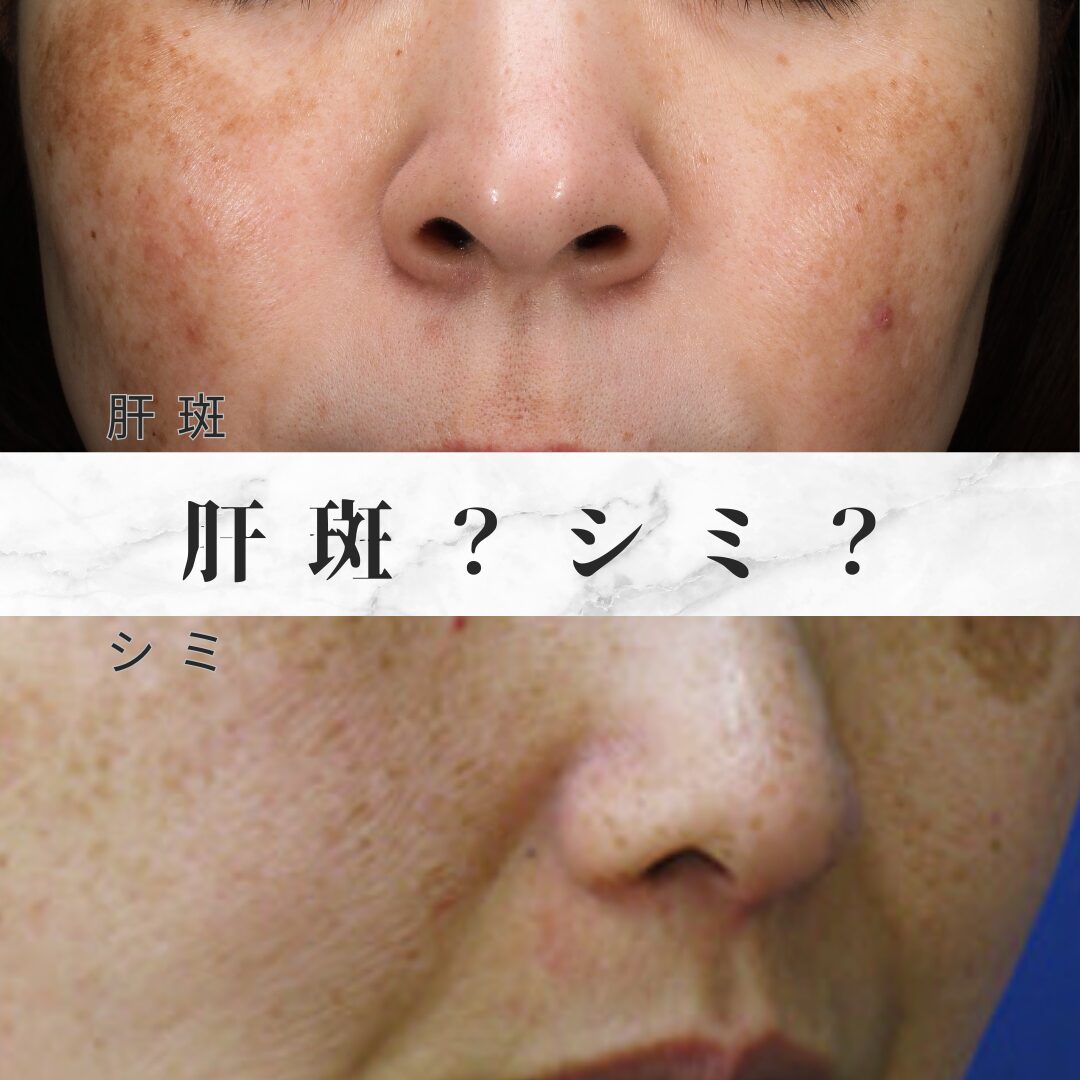 肝斑とシミの見分け方を専門医が解説！間違うと悪化するNgケア