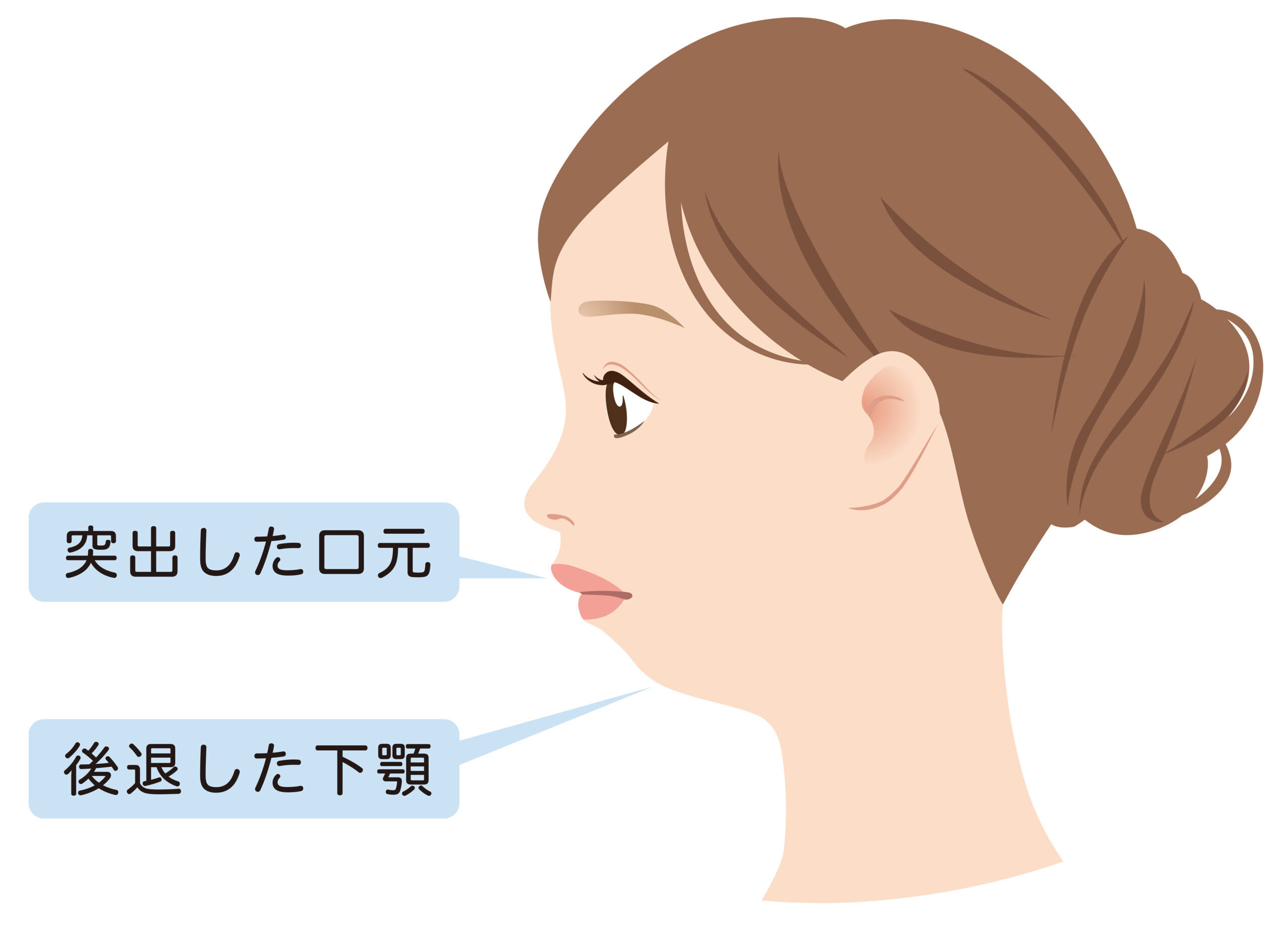 横顔の違和感を徹底解剖！顎がない顔の原因と劇的改善アプローチ