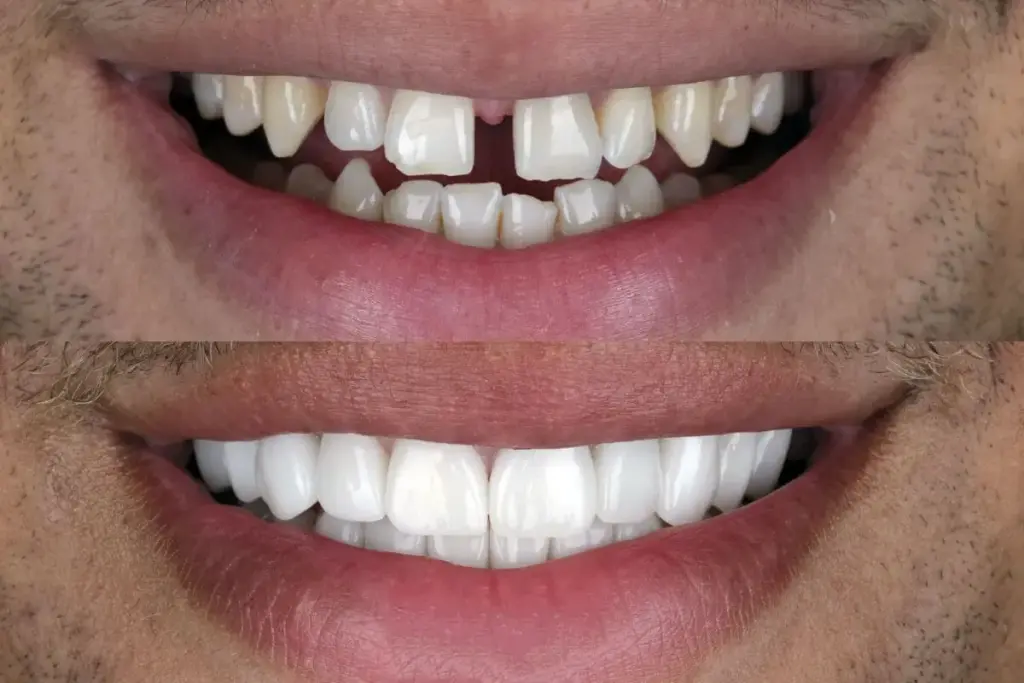 Porcelain Veneers Before and After Kpop