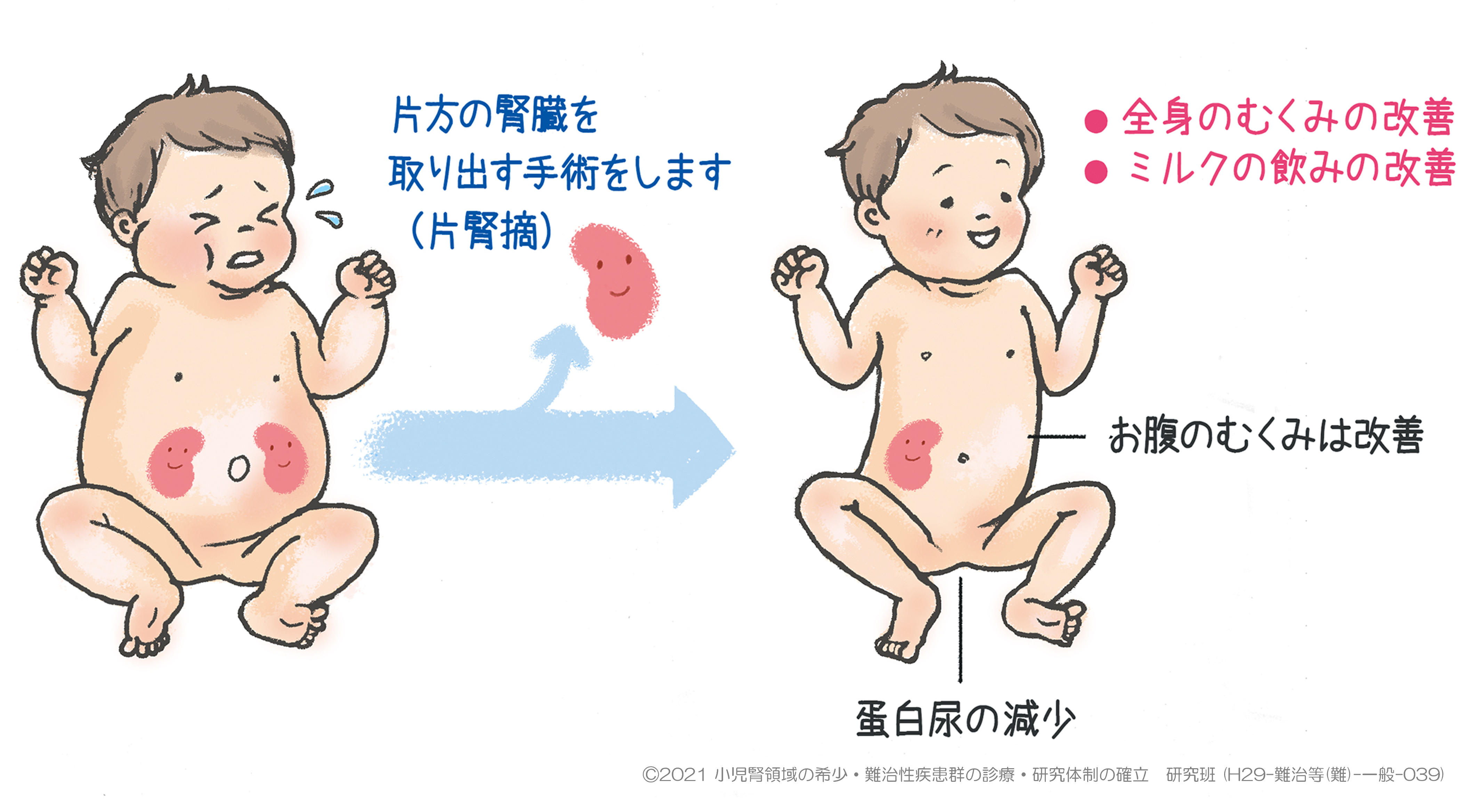 片腎でも寿命や生活は平気？生まれつきや摘出後のリスクと対策の真実