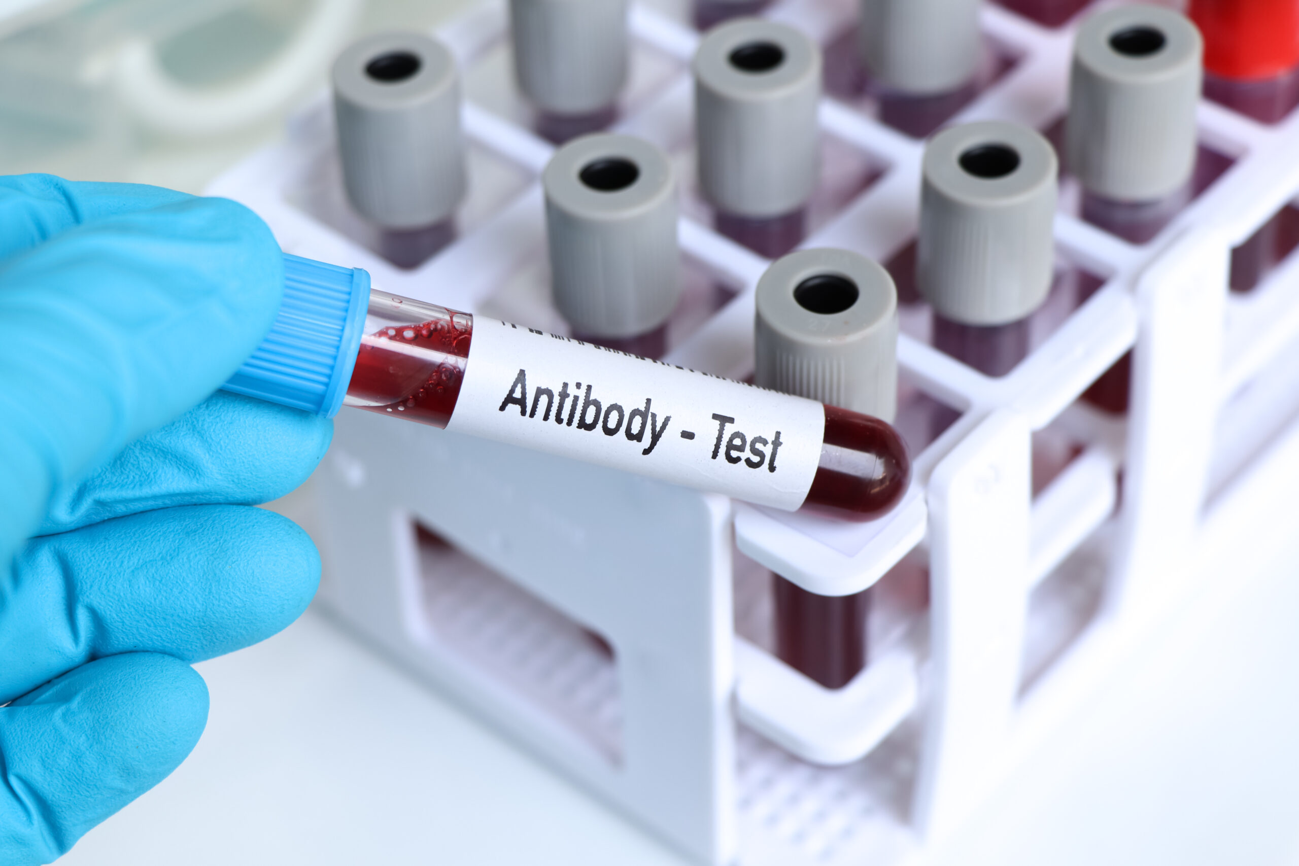 How Much Is a Antibody Test