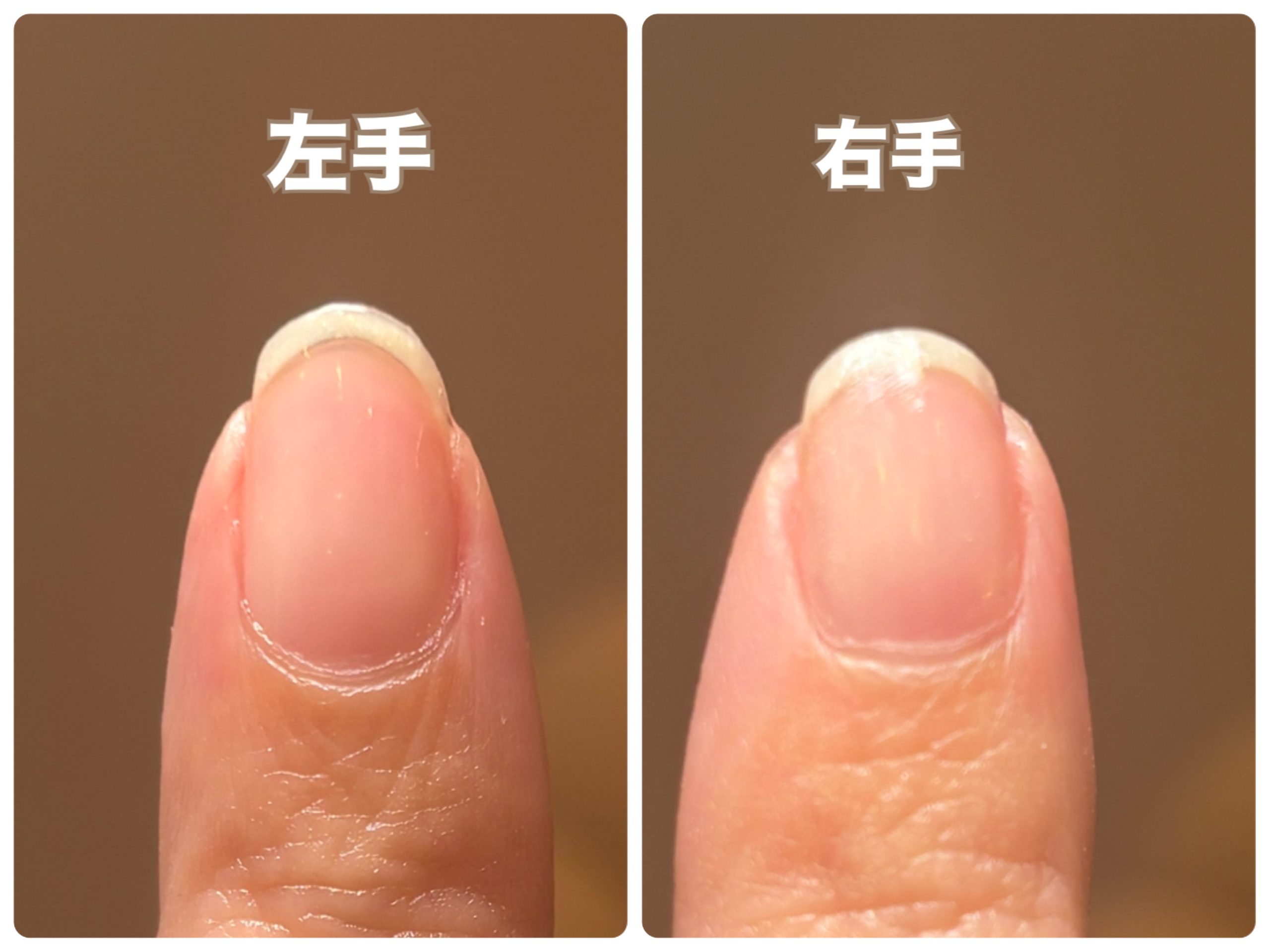 爪のピンクの部分を伸ばす秘訣！深爪脱却とハイポニキウム育成の真相