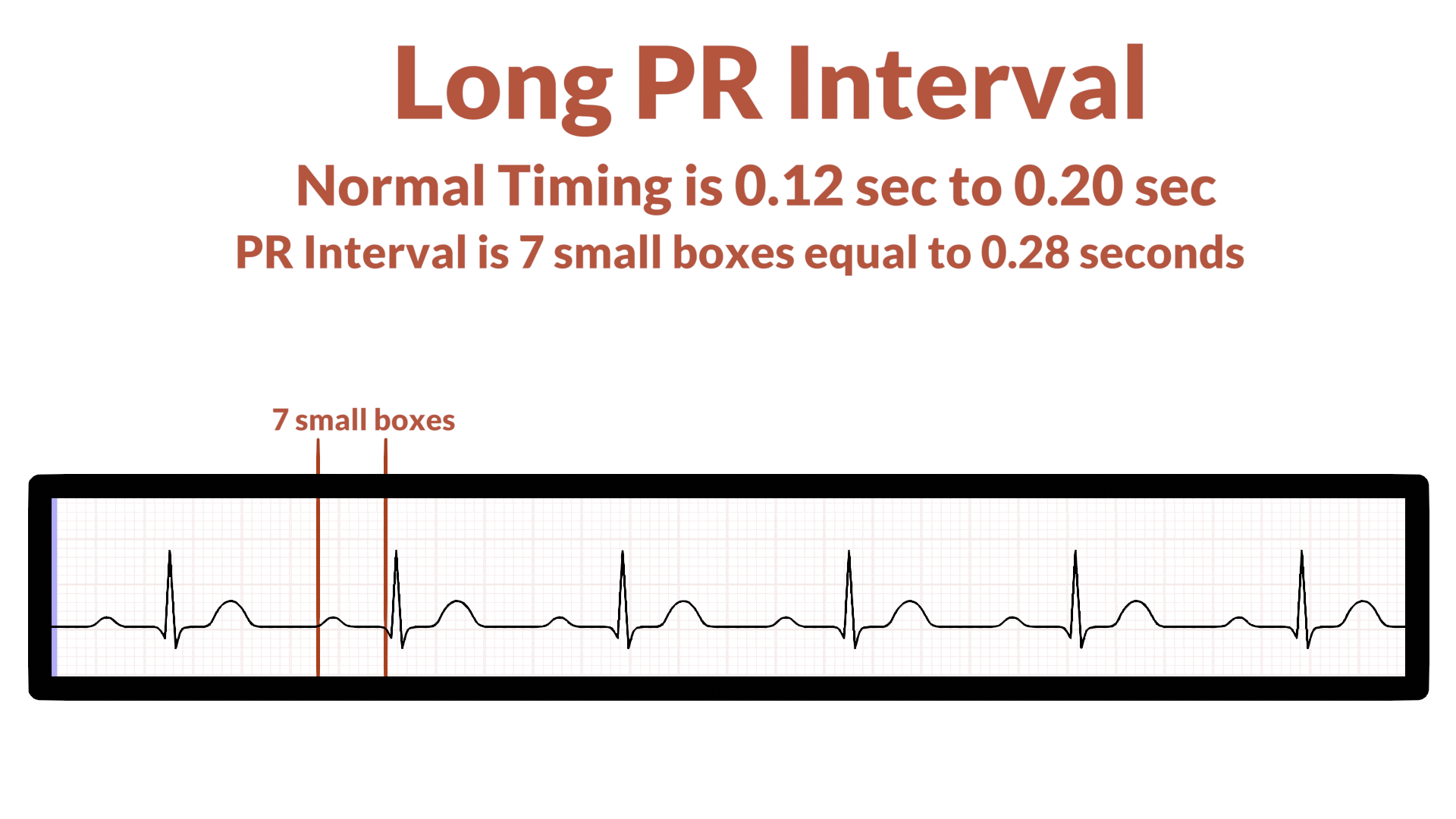 What Does Prolonged Pr Interval Mean