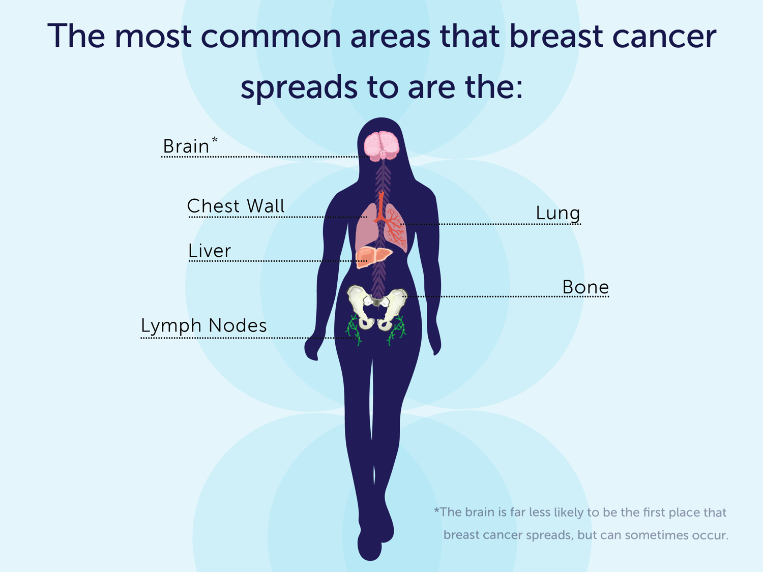 Signs That Breast Cancer Has Spread to the Bones