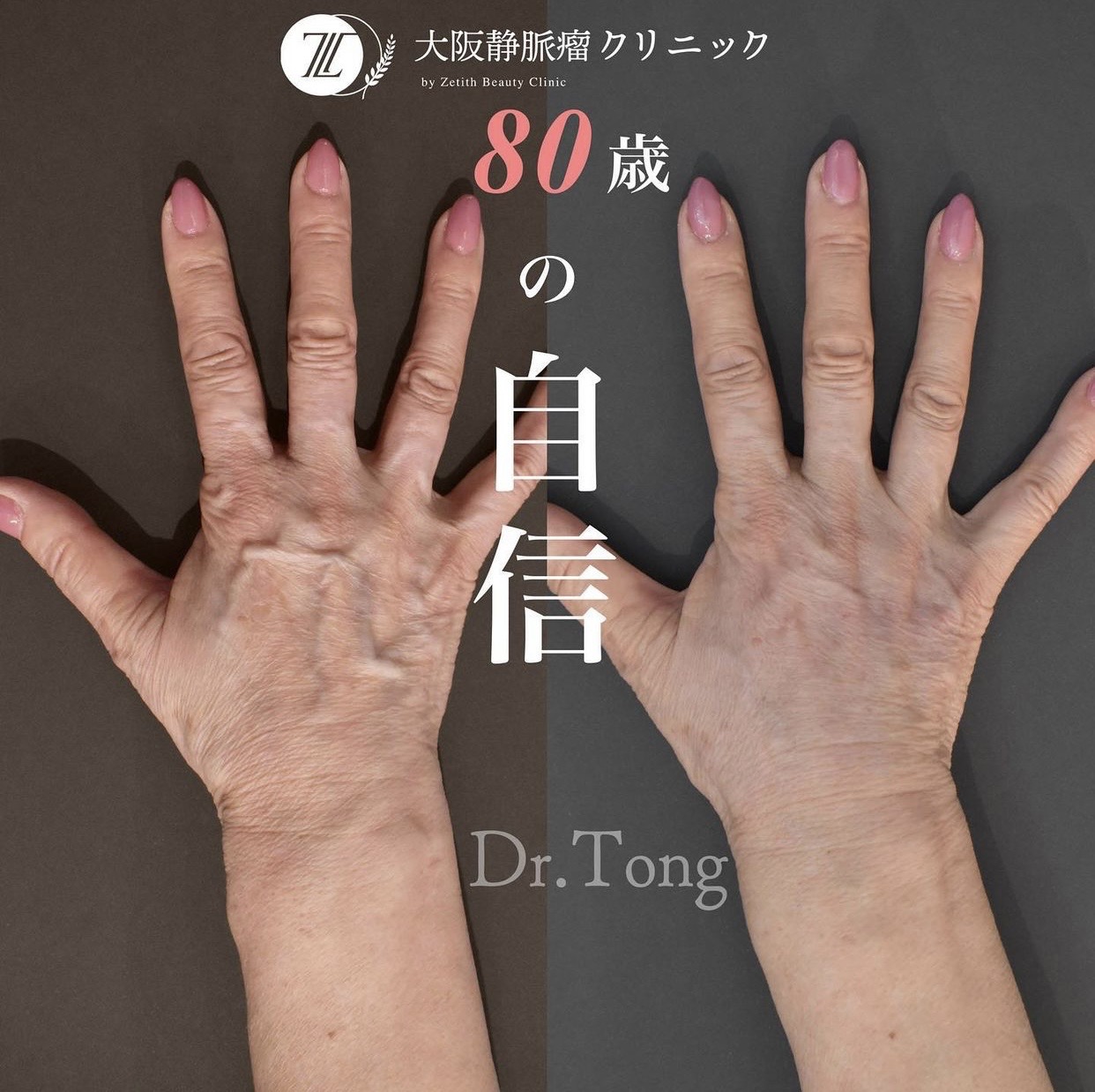 手の血管が浮き出る原因と病気のサイン｜治す方法と最新治療