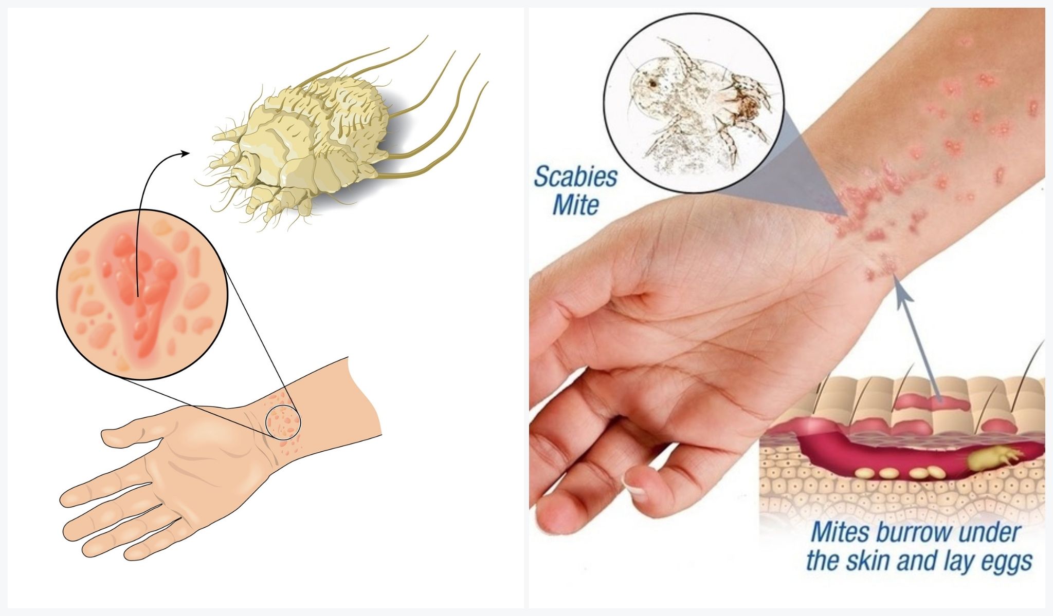 Will Scabies Rash Come and Go