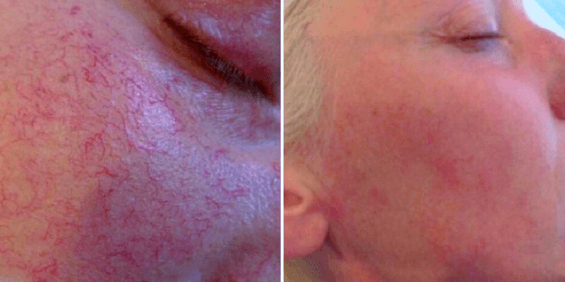 Red Light Therapy for Broken Capillaries