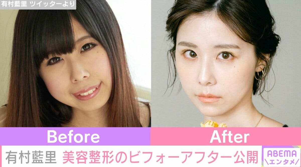 有村藍里が整形を公表した理由とは？骨切り手術の真相と現在の姿