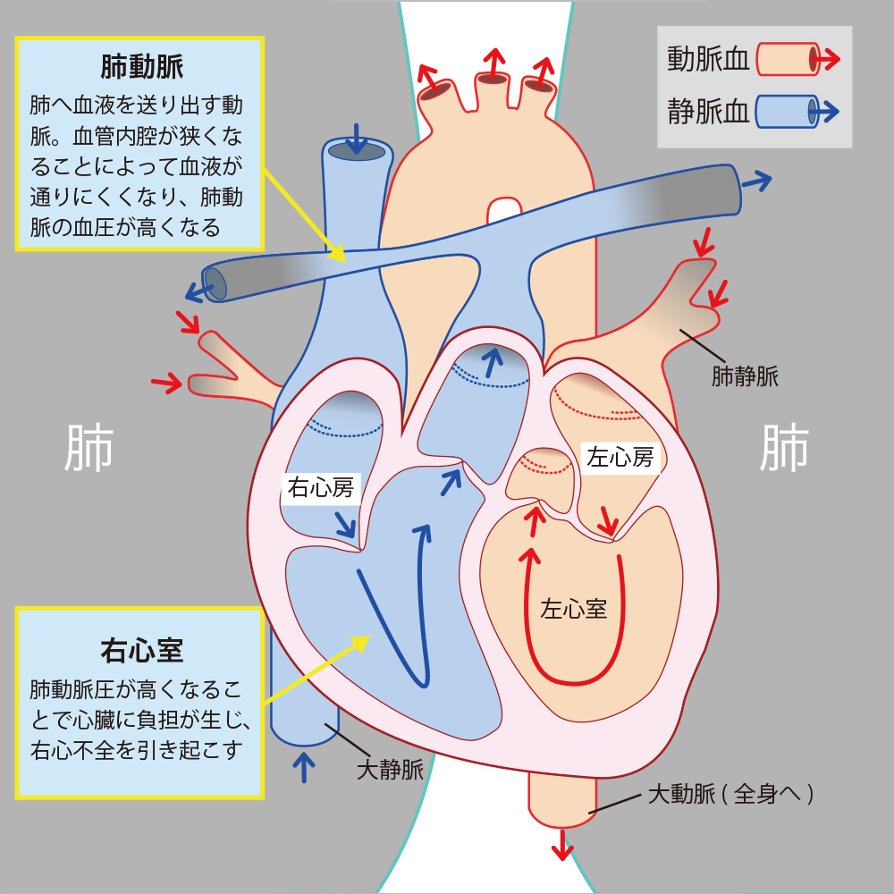 肺高血圧症の初期症状と余命の真実｜2026年最新治療と難病認定を徹底解説
